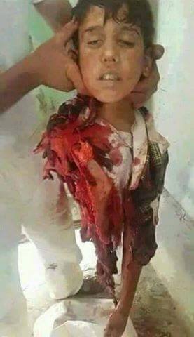 ارسال تصویر کودک یمنی « نیمه بدن » توسط «اندی وینسنت » فعال حقوق بشر 18+