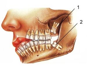 دندان عقل عضو جداناپذیر