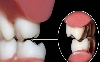 نکاتی مهم درباره دندان قروچه کودکان که شاید والدین ندانند!
