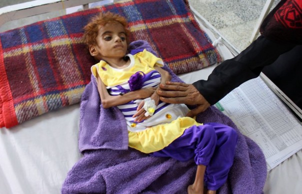 یمن، بدترین قحطی در 100 سال