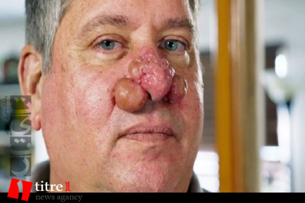 جراحی توده های چرکی روی بینی با بوی بسیار بد + تصاویر