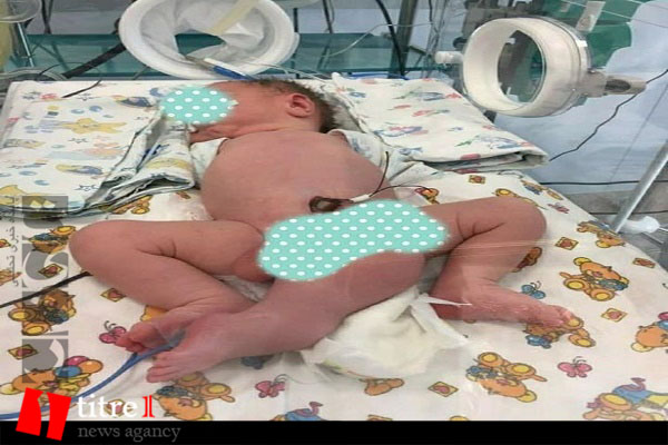 تولد نوزاد سه پا در روسیه + تصاویر