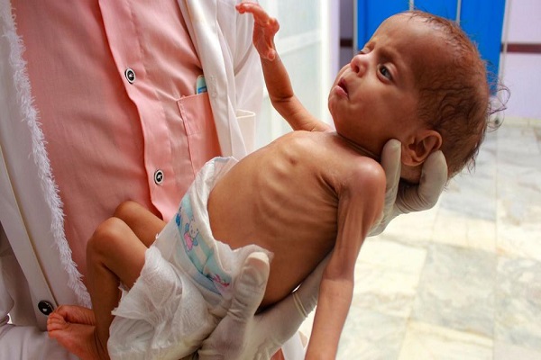 وقوع تراژدی نسلی در یمن/ مرگ هزاران کودک در دوران کووید19 به خاطر قحطی