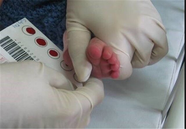 جزئیات غربالگری کم‌کاری تیروئید در نوزادان / افزایش اختلالات تیروئیدی با ابتلا به کرونا