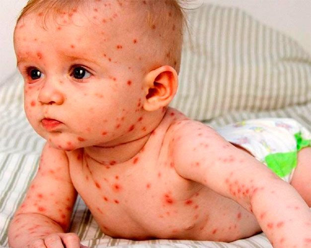 بیماری پائیزی سرخک در کمین کودکان البرز
